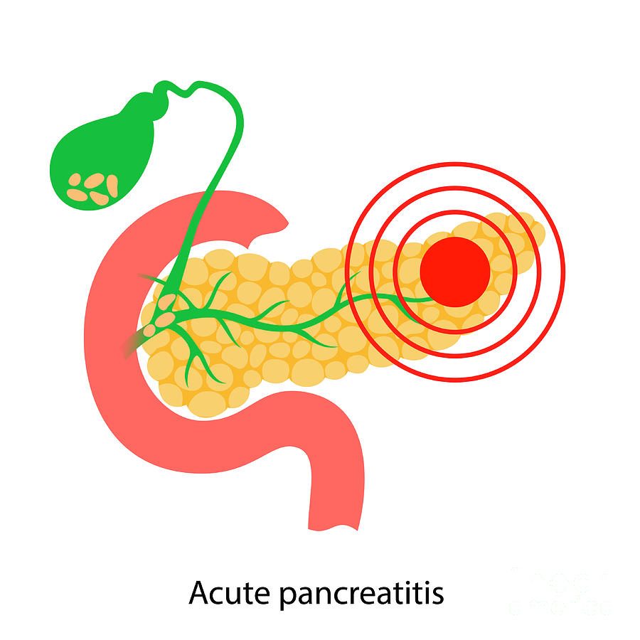 Acute Pancreatitis #1 Photograph by Pikovit / Science Photo Library