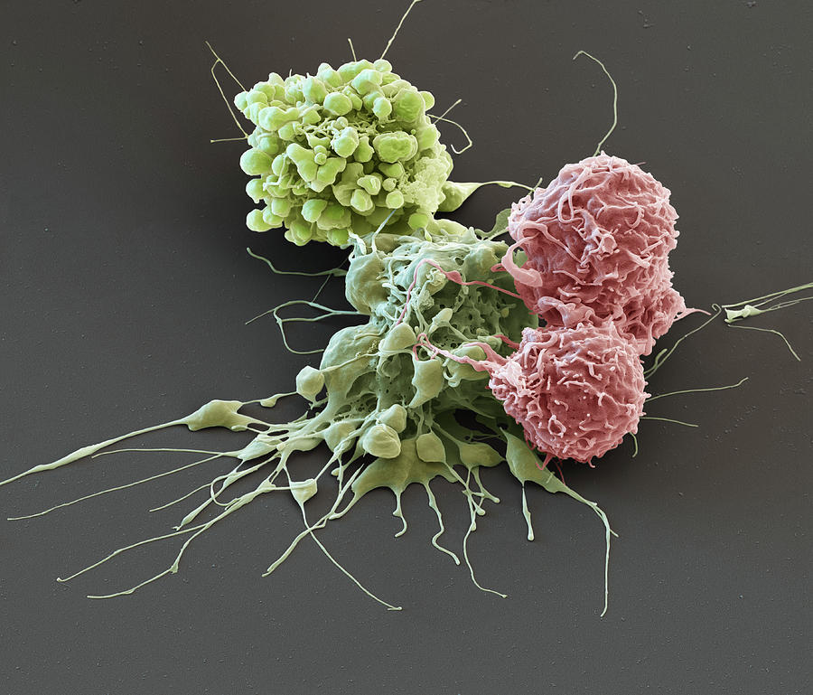 Adenocarcinoma Cells, Sem Photograph by Oliver Meckes EYE OF SCIENCE ...