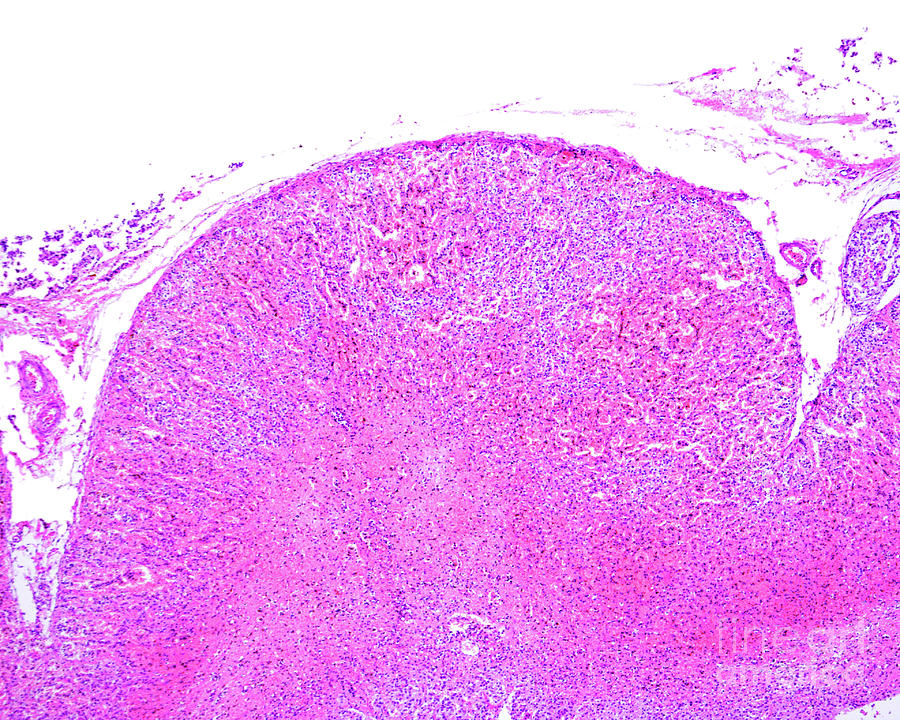 Adrenal Haemorrhage Photograph by Jose Calvo / Science Photo Library ...