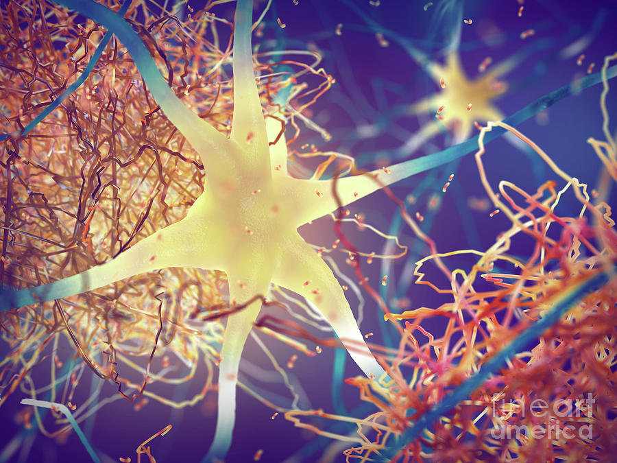 Amyloid Plaques In Alzheimer's Disease Photograph by Nobeastsofierce