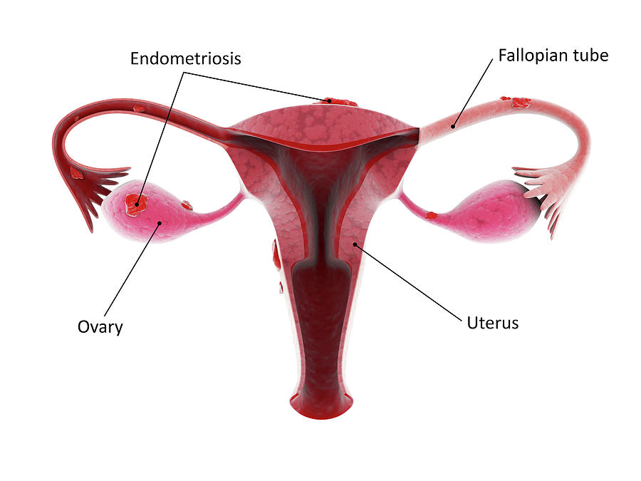 An Unhealthy Female Reproductive Organ #1 Photograph by Stocktrek Images