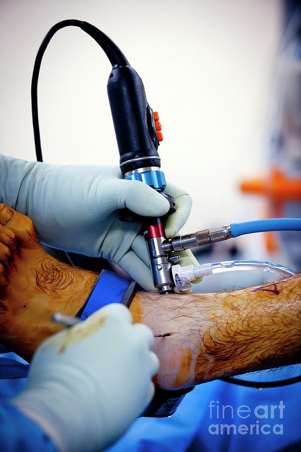 Ankle Arthroscopy Photograph By Jim Varney Science Photo Library Fine