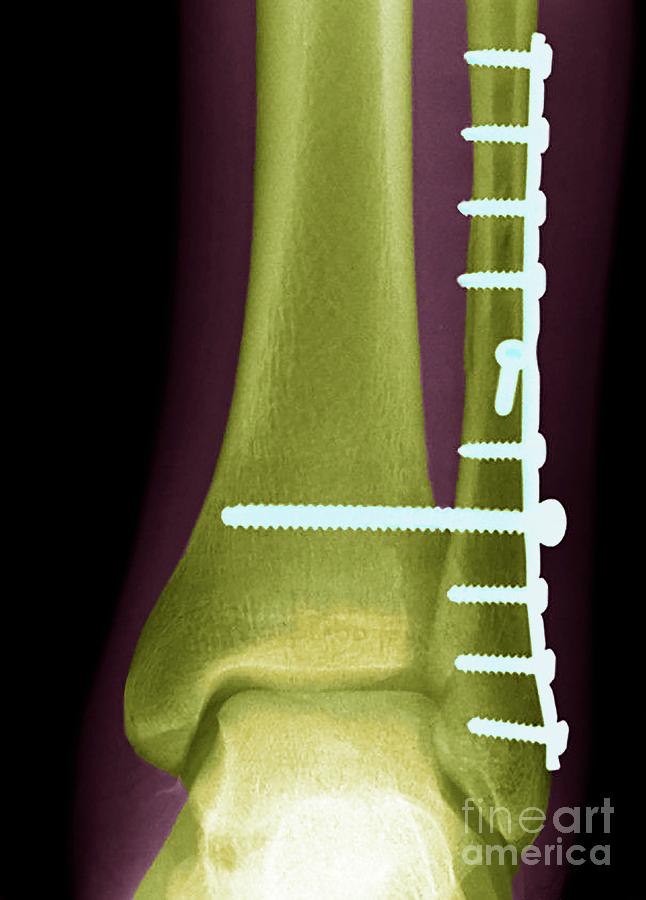 Screw Photograph - Ankle Fracture #1 by Steve Gschmeissner/science Photo Library