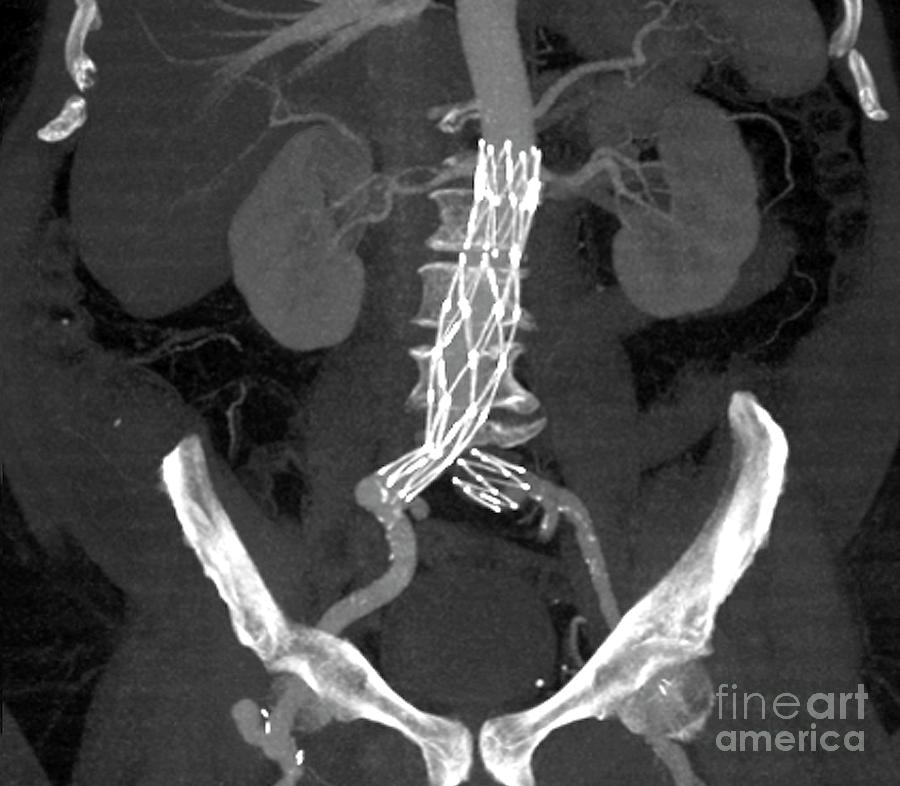 Aortic Aneurysm Stent Photograph By Zephyrscience Photo Library 2550