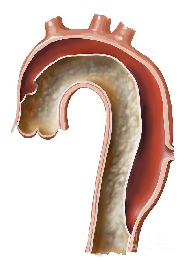 Aortic Dissection Photograph By Medical Graphicsmichael Hoffmannscience Photo Library Pixels 6196