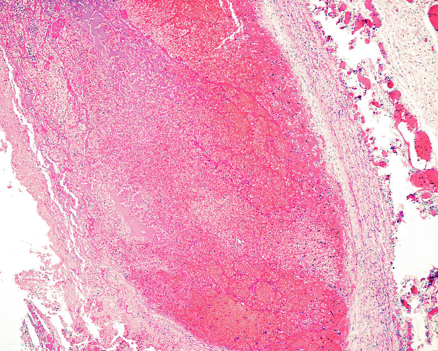 Arterial Thrombosis #1 Photograph by Jose Calvo / Science Photo Library ...