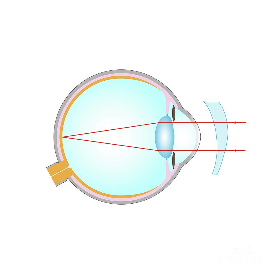 Astigmatism Corrected With A Lens Photograph by Cordelia Molloy/science ...