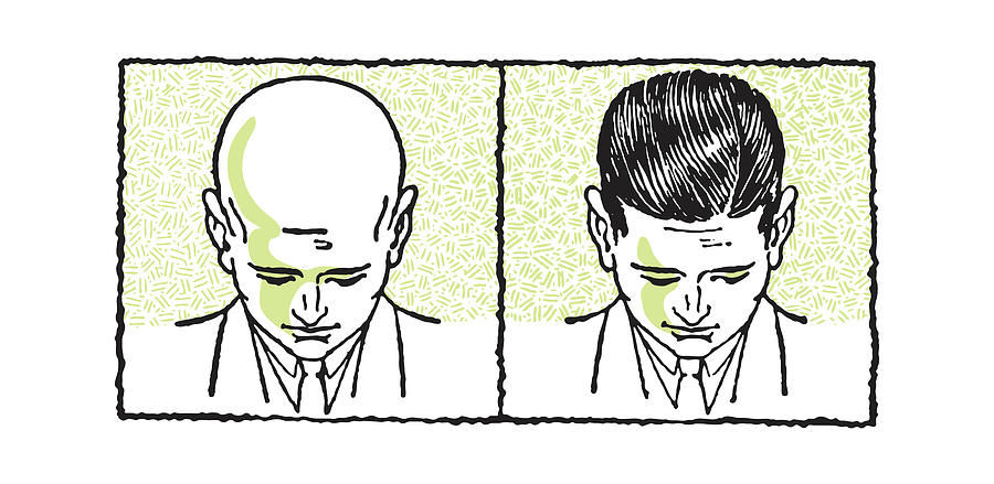 Vintage Drawing - Before-and-After of Bald Man Growing Hair #1 by CSA Images