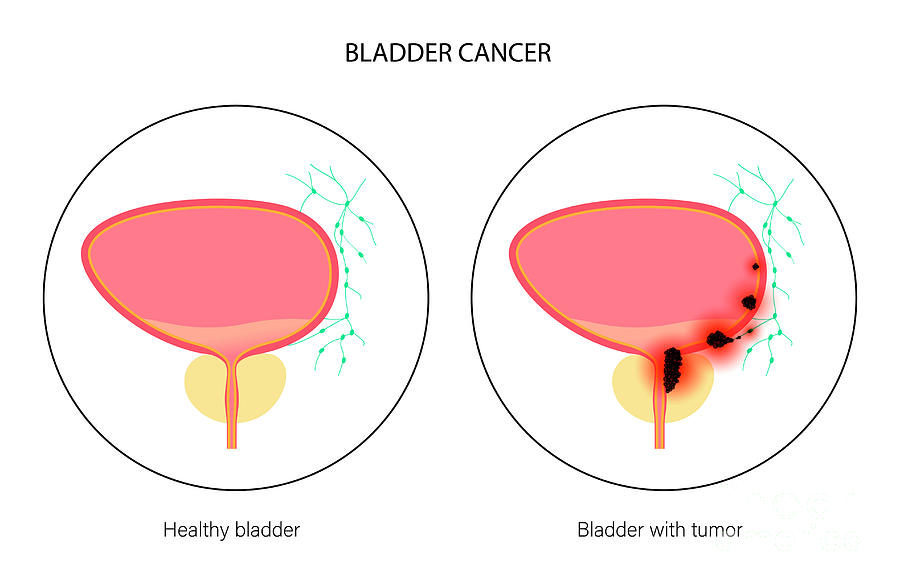 Bladder Cancer Stages Photograph by Pikovit / Science Photo Library ...