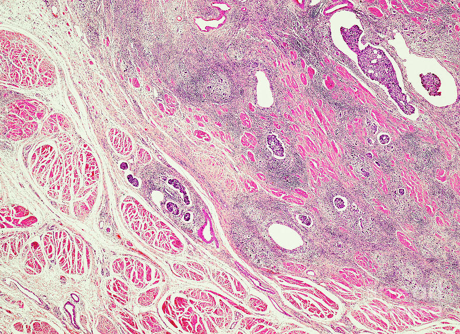 Bladder Transitional Cell Carcinoma Photograph By Nigel Downer Science 