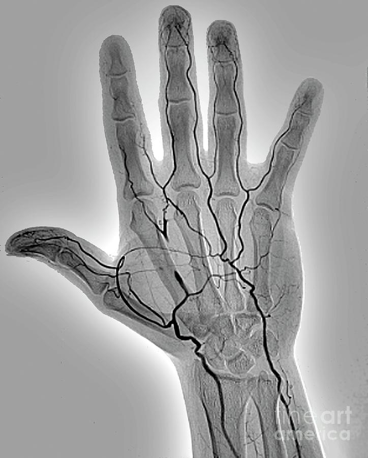 Blocked Hand Artery #1 Photograph by Zephyr/science Photo Library