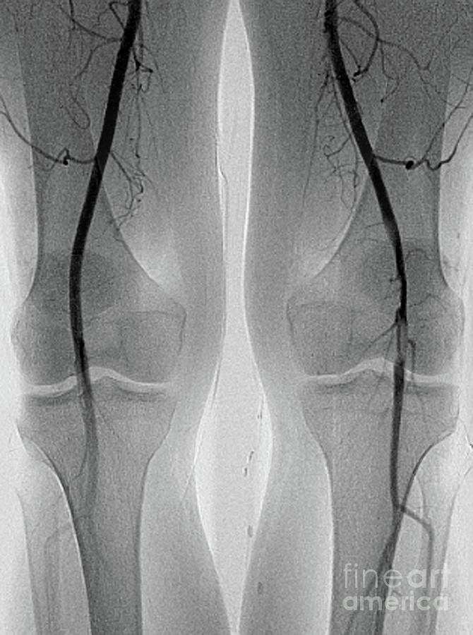 Blocked Knee Artery #1 Photograph by Zephyr/science Photo Library
