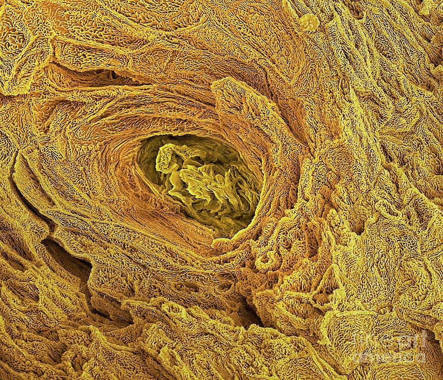 Blocked Sweat Gland #1 Photograph by Steve Gschmeissner/science Photo Library