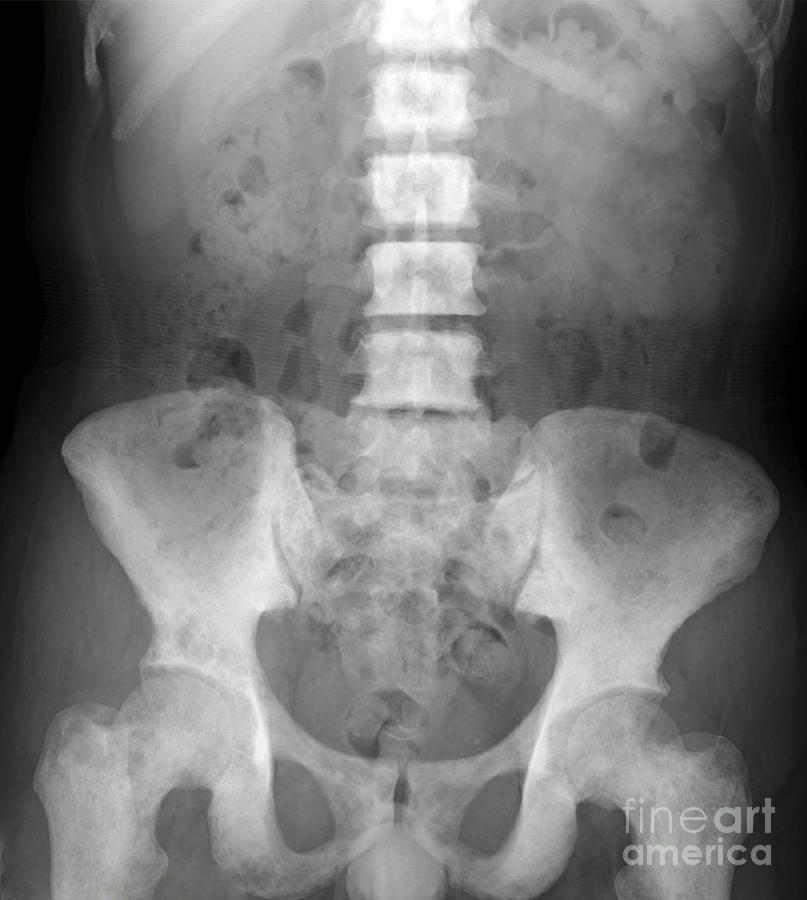 Bone Metastasis Of The Pelvis Photograph by Rajaaisya/science Photo ...