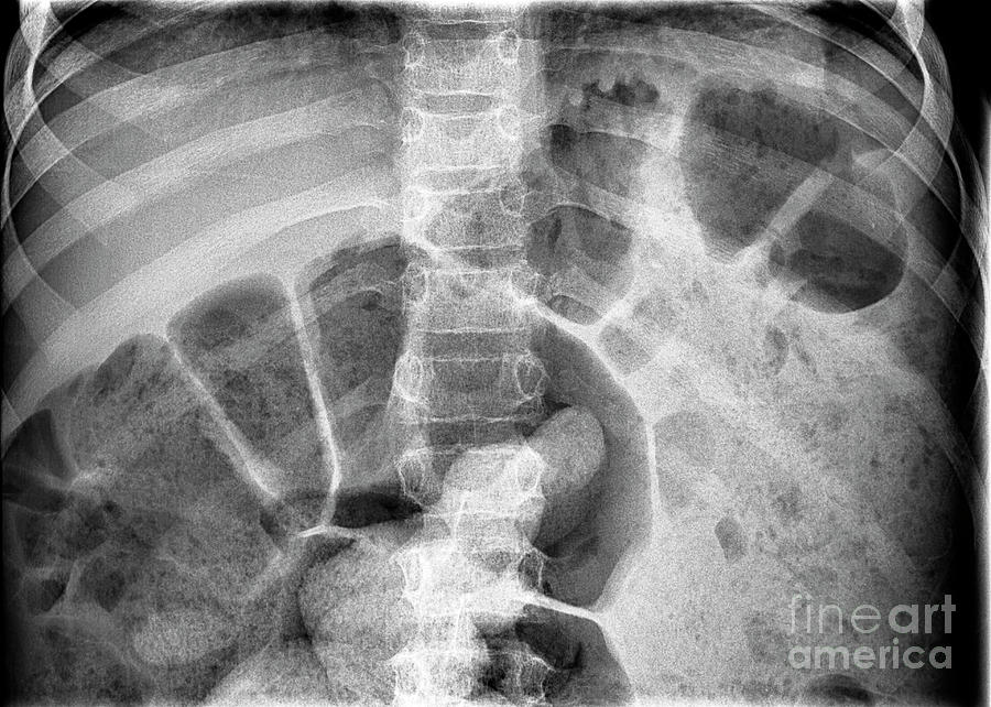 Bowel Obstruction #1 Photograph by Science Photo Library