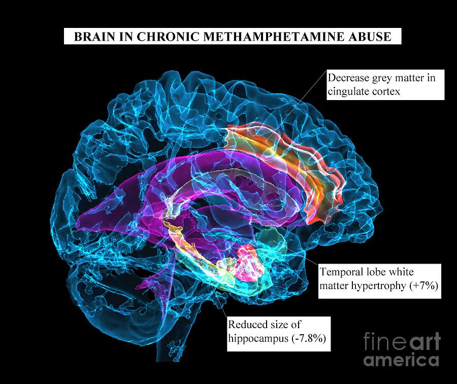 Brain Affected By Chronic Methamphetamine Abuse #1 Photograph by K H Fung/science Photo Library Brain Affected By Chronic Methamphetamine Abuse #1 Photograph by K H Fung/science Photo Library