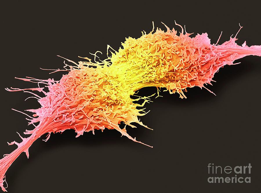 Brain Cancer Cells Photograph By Steve Gschmeissner Science Photo