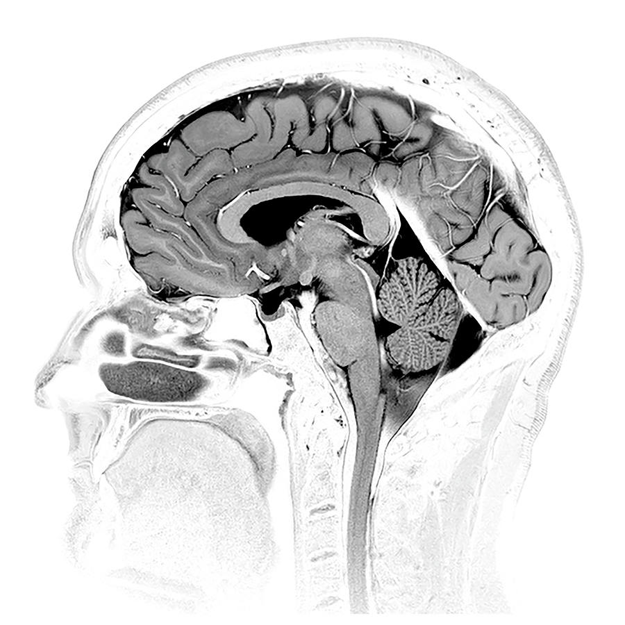Brain Mri, Normal #1 Photograph by Living Art Enterprises - Fine Art ...