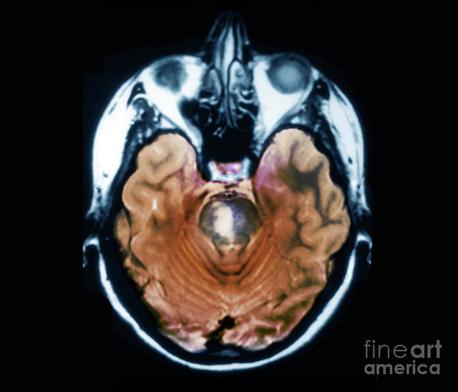 Brainstem Stroke #1 Photograph by Zephyr/science Photo Library