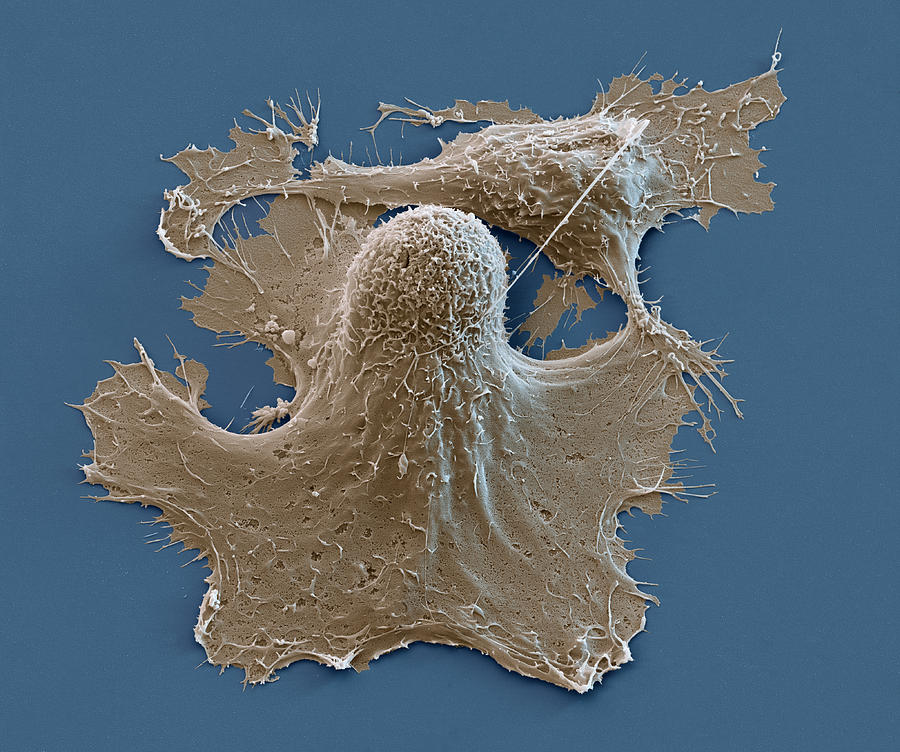 Breast Cancer Cells, Sem #1 Photograph by Meckes/ottawa