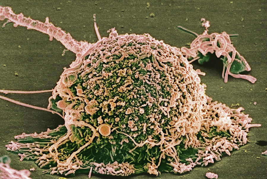 Breast Cancer Tumor Cell, Sem #1 Photograph by Biophoto Associates