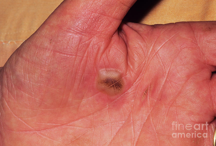 burn blister burn blister