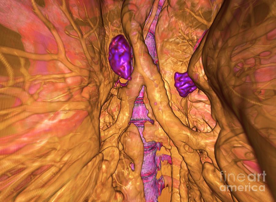 Calcified Lung Lymph Nodes #1 Photograph by K H Fung/science Photo Library