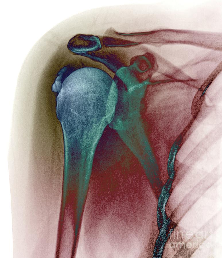 Calcified Tendinitis #1 Photograph by Zephyr/science Photo Library