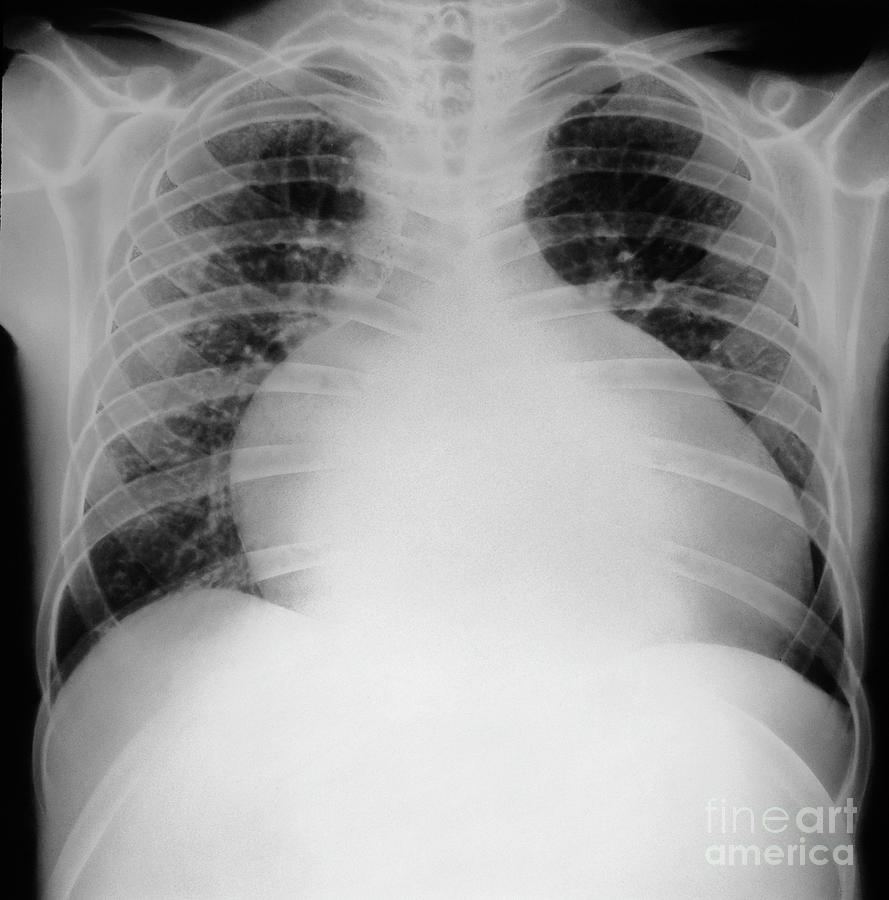 Cardiomyopathy #1 Photograph by Simon Fraser/science Photo Library - Pixels