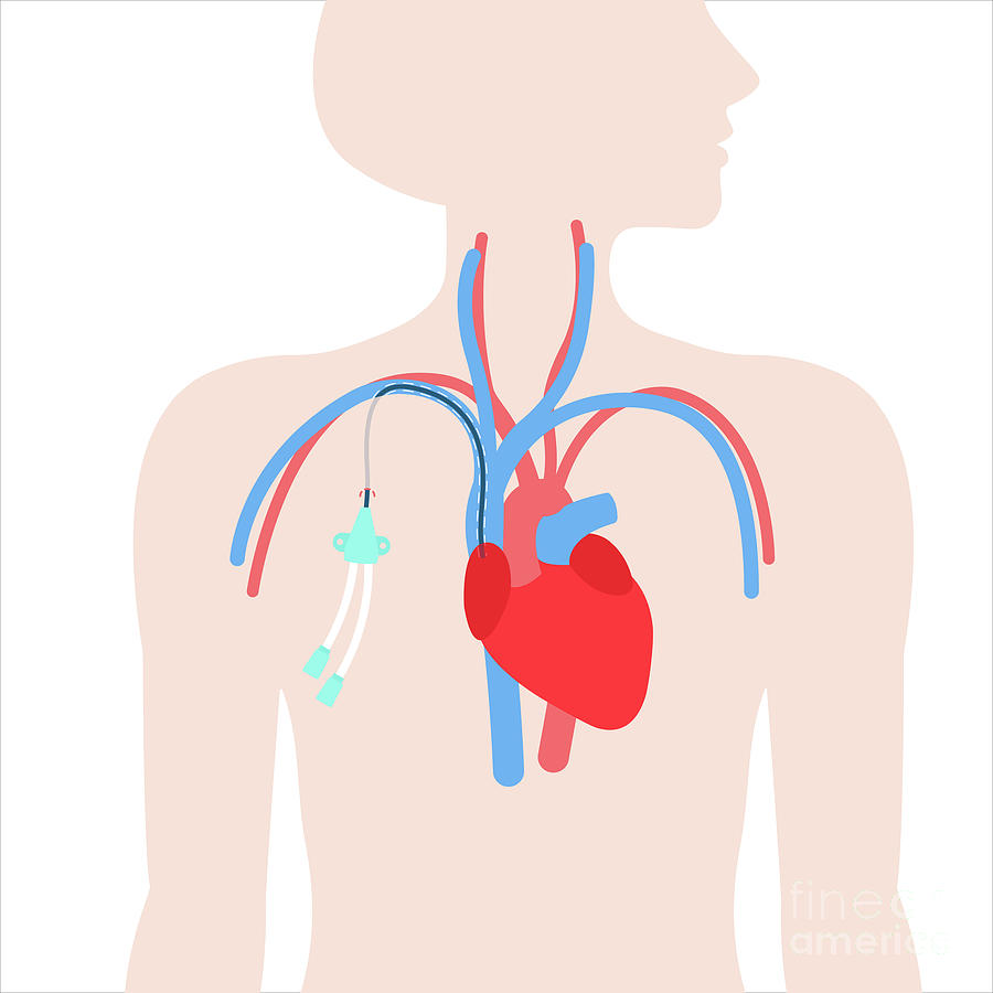 Central Venous Catheter 1 Photograph By Art4stockscience Photo