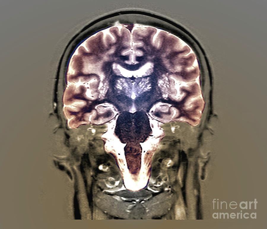 Cerebral Atrophy Photograph By Zephyrscience Photo Library Fine Art
