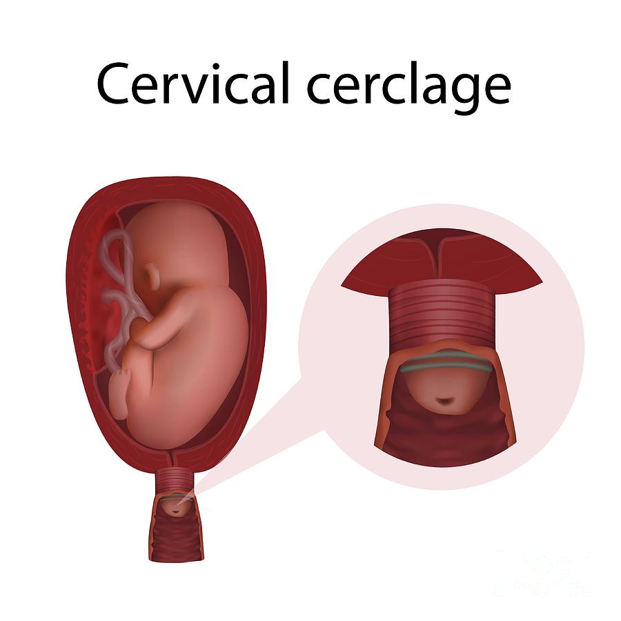 Cervical Cerclage Photograph By Veronika Zakharovascience Photo Library 9173