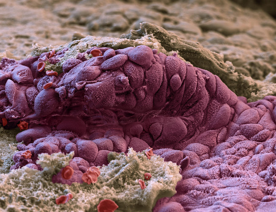 Cervical Polyp Sem Photograph By Oliver Meckes Eye Of Science Fine Art America