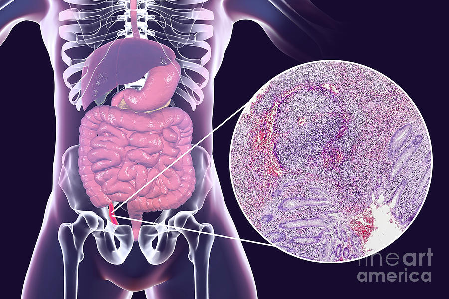 Chronic Appendicitis  Photograph by Kateryna Kon science 