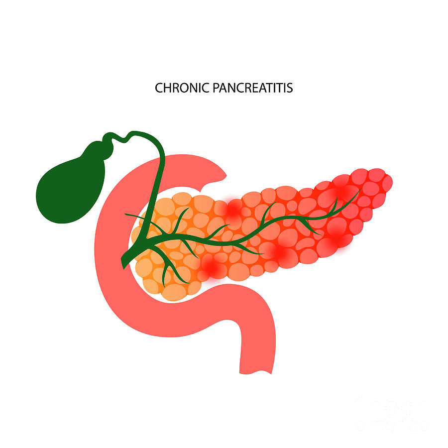 Chronic Pancreatitis #1 Photograph by Pikovit / Science Photo Library