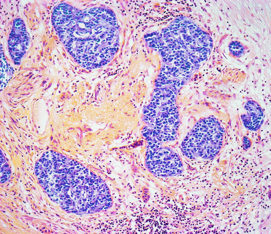 Chronic Pancreatitis #1 Photograph by Steve Gschmeissner/science Photo Library