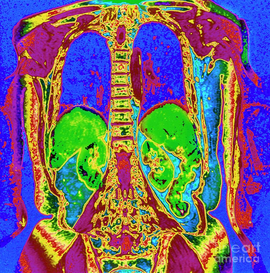 Col. Mri Scan Of Thorax & Abdomen Of Elderly Woman #1 by Simon Fraser ...