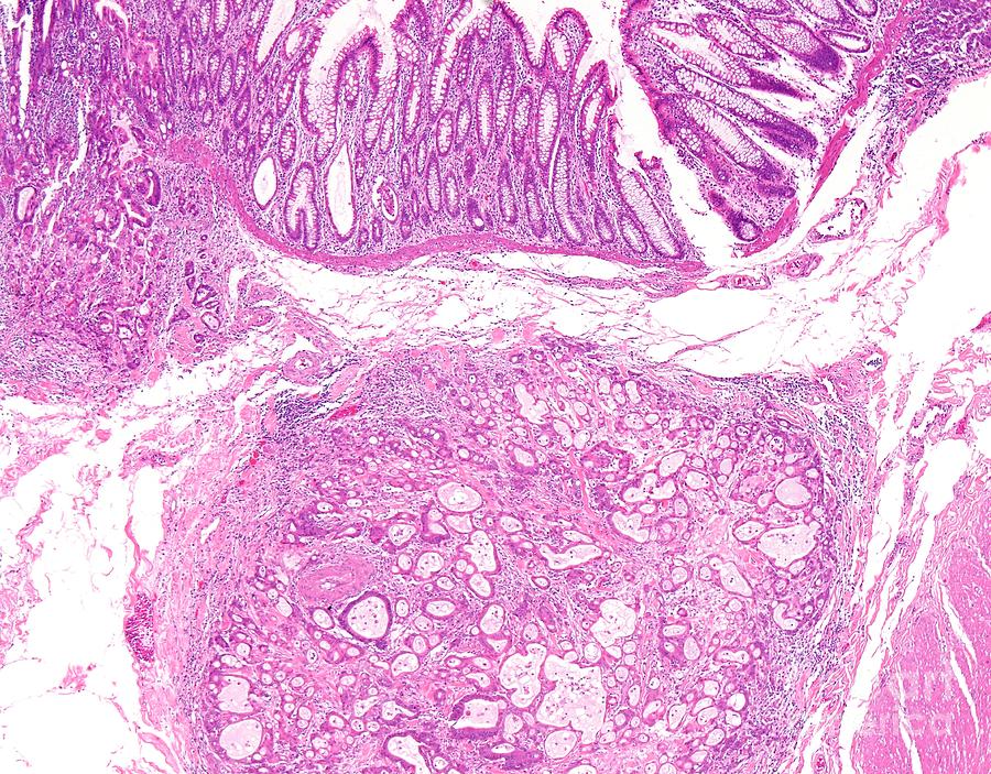 Colon Cancer Due To Genetic Mutation Photograph By Webpathologyscience Photo Library 7539
