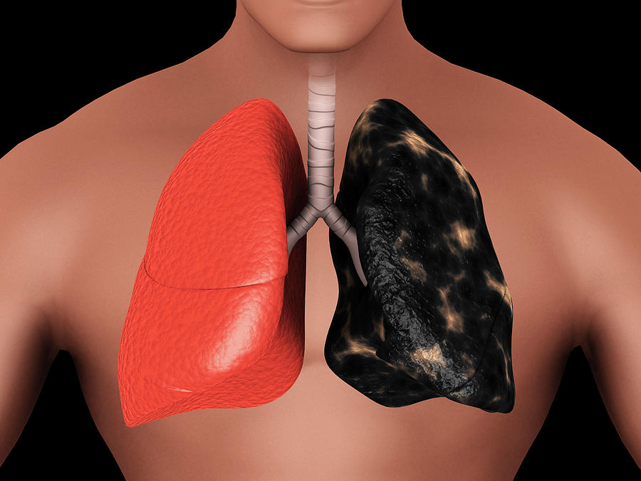 Comparison Of A Healthy Lung Vs #1 Photograph by Stocktrek Images