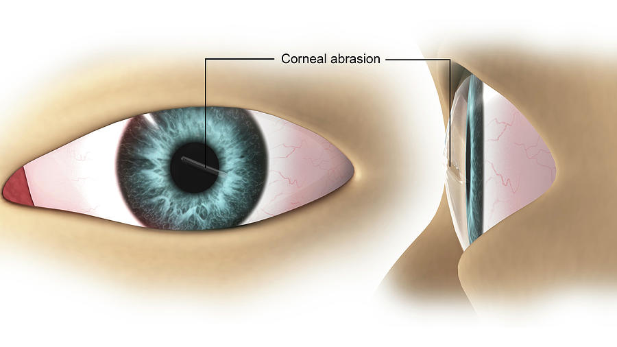 Corneal Abrasion In The Human Eye Photograph by Stocktrek Images - Fine ...