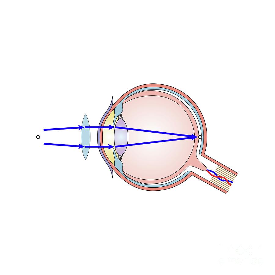 Corrected Long-sightedness Photograph by Science Photo Library | Pixels