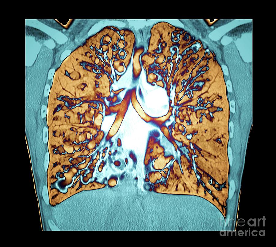 Cystic Fibrosis #1 by Zephyr/science Photo Library