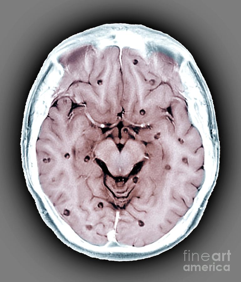 Cysticercosis Of The Brain Photograph by Zephyr/science Photo Library ...