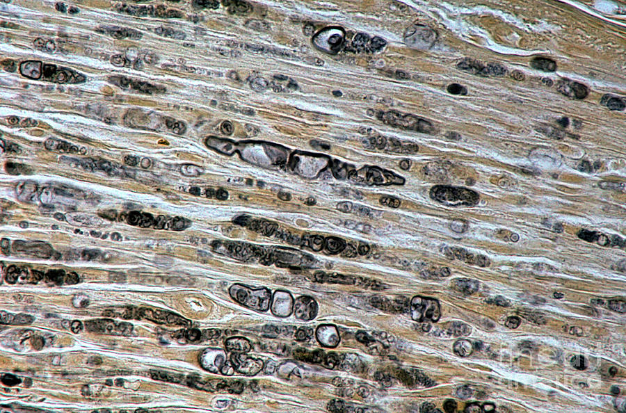 Damaged Myelinated Fibres #1 Photograph by Jose Calvo / Science Photo Library