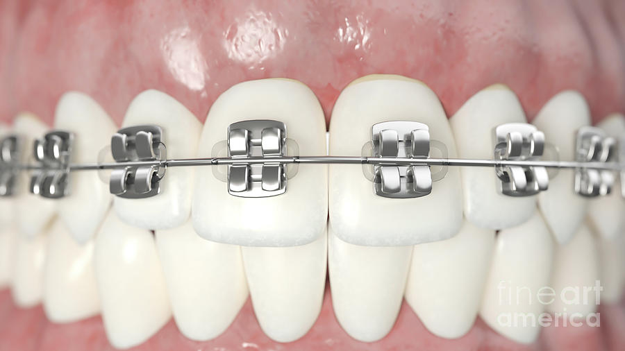 Dental Braces Photograph by Sebastian Kaulitzki/science Photo Library