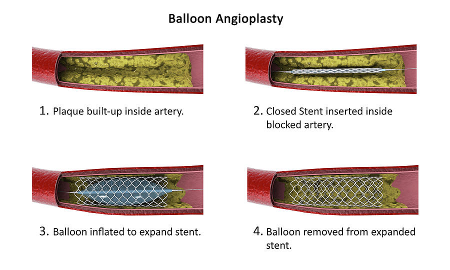 Diagram Showing Procedure Of Balloon #1 Photograph by Stocktrek Images