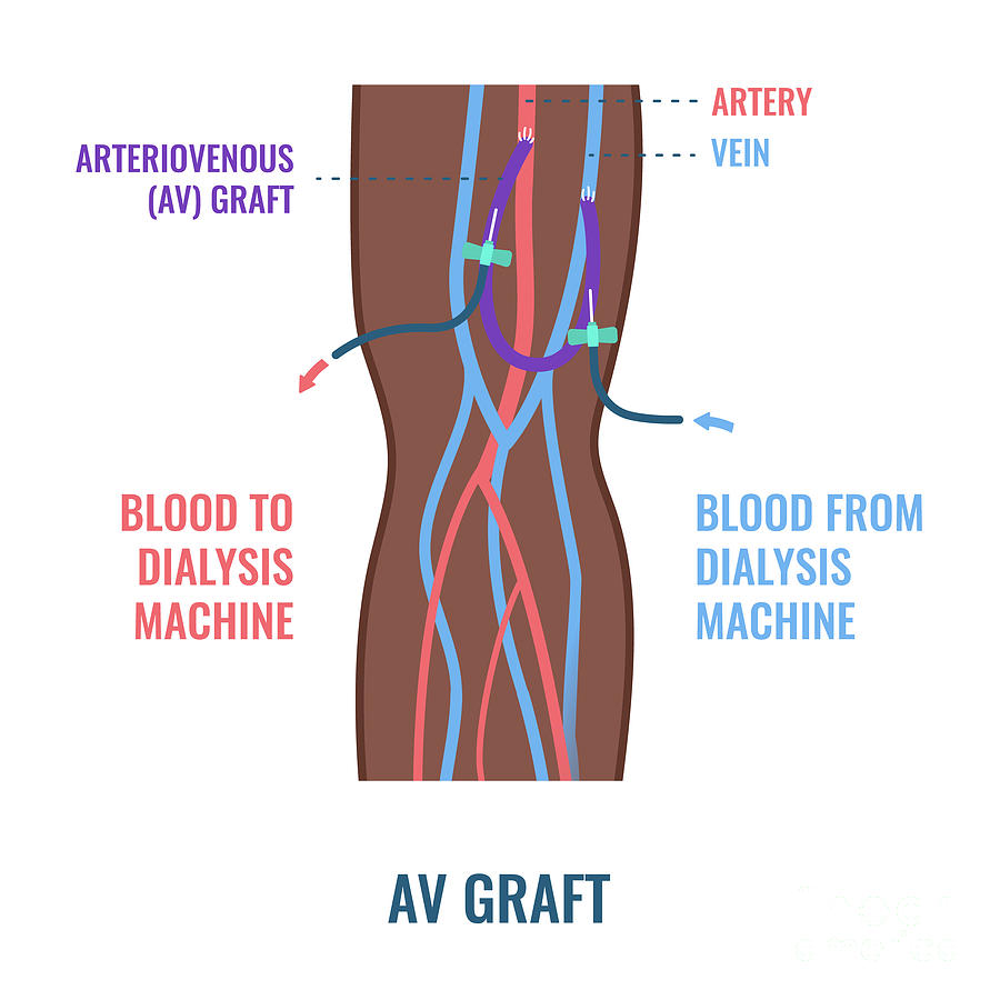 Dialysis Shunt Graft Catheter #1 Photograph by Science Photo Library ...