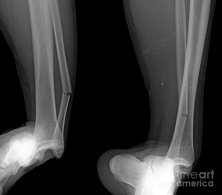 Dislocated Ankle #1 Photograph by Rajaaisya/science Photo Library