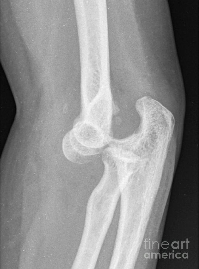 Dislocated Elbow Photograph by Rajaaisya/science Photo Library Pixels