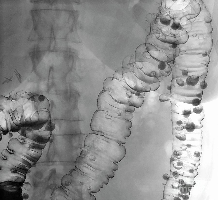 Diverticulosis Photograph - Diverticulosis In Large Intestine #1 by Gastrolab/science Photo Library